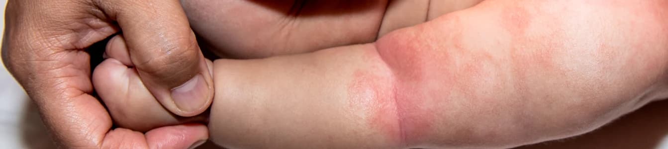 Dermatitis Seboroik